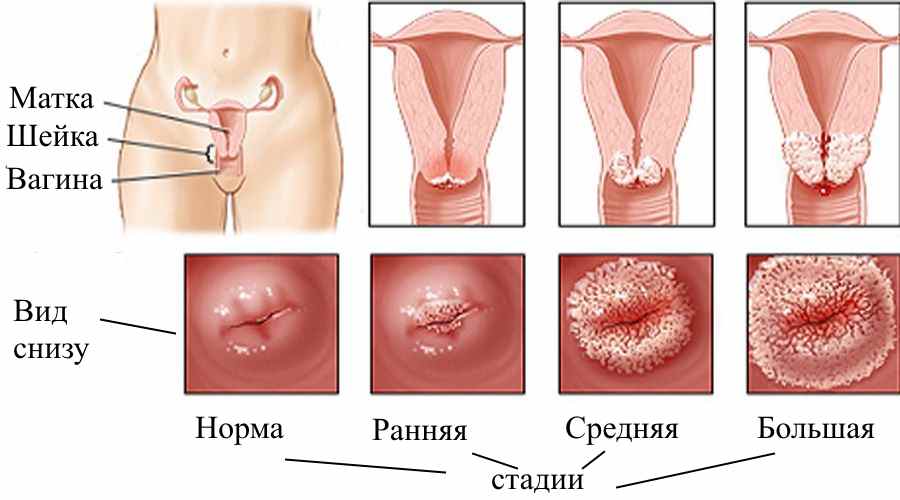Эрозия шейки матки, миома и эндометриоз как обнаружить и вылечить
