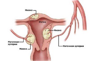 Эрозия шейки матки, миома и эндометриоз как обнаружить и вылечить1