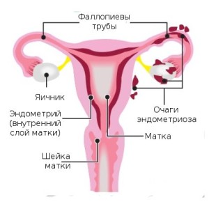 Эрозия шейки матки, миома и эндометриоз как обнаружить и вылечить2